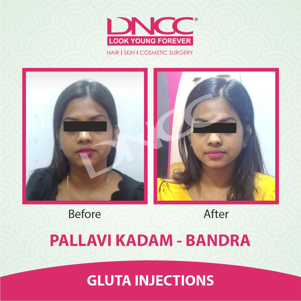 Hair Transplant Transformation 1
